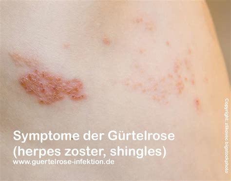 G Rtelrose Patienteninformationen Zu Herpes Zoster