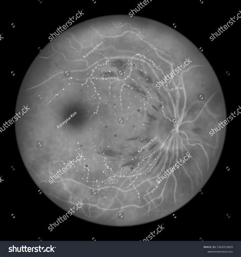 Nonproliferative Diabetic Retinopathy Illustration Shows Irmas Stock