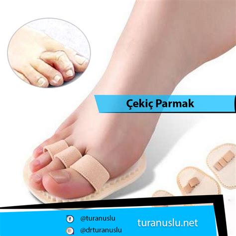 Çekiç Parmak Beyzbolcu Parmağı Prof Dr Turan Uslu