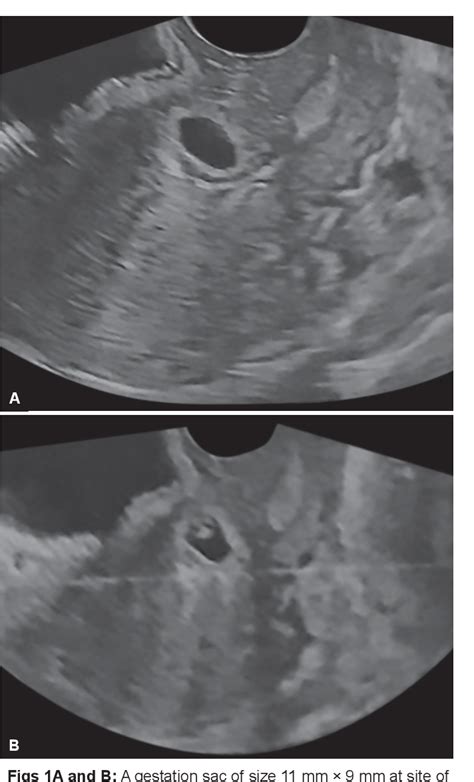 Figure 1 From Laparoscopic Management Of Cesarean Section Scar Ectopic