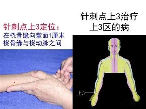 针灸微针腕踝针疗法 知乎