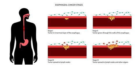 Premium Vector | Esophageal cancer stages