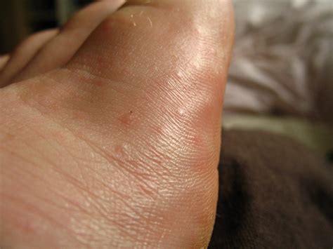 Little Bumps On Foot Funky Rash On My Foot Tanja Flickr