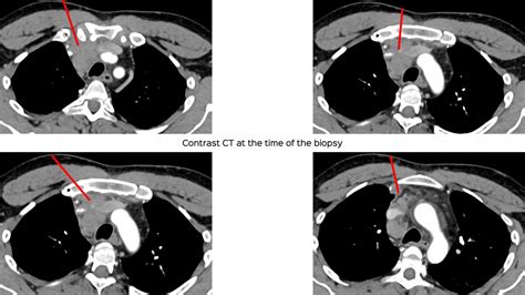 Case 137: Prevascular Space Mediastinal Lesion for Biopsy - What is ...