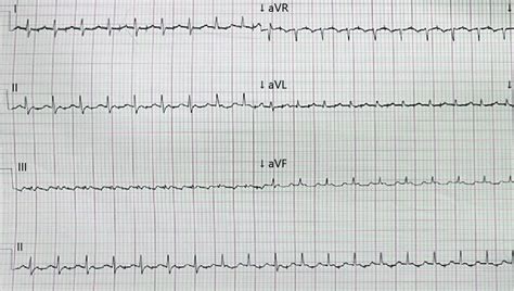 Twelve Lead Electrocardiogram Obtained During An Episode Of Tachycardia Download Scientific