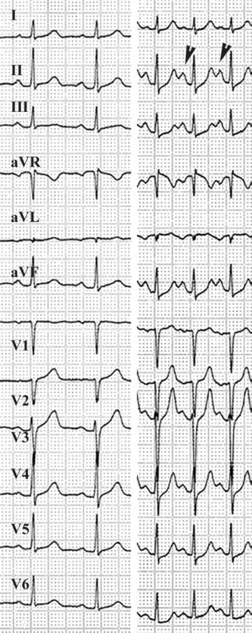 Prevalences and univariate comparisons of major ECG criteria for AVNRT ...