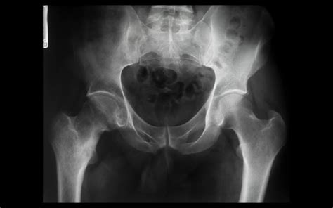 Chronic Osteomyelitis Brodies Abscess Calcar Femur Xr Flickr Photo Sharing