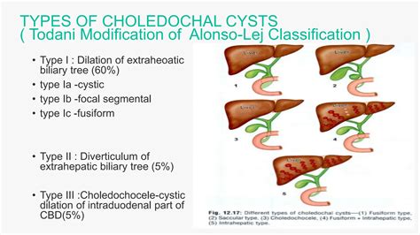 Choledochal Cysts Description Done Pptx Ppt