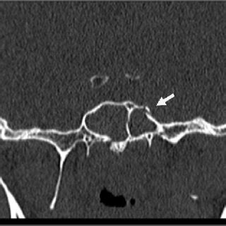 Computed tomography image in cronal view showing sphenoid bone fracture ...