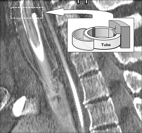 Three Dimensional Computed Tomographic Reconstruction Demonstrating Download Scientific Diagram