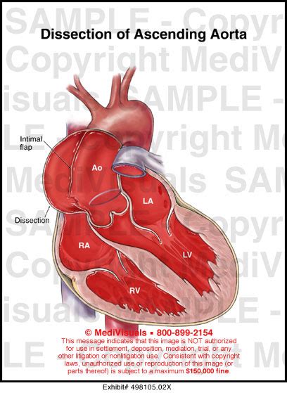 Dissection Of Ascending Aorta Medical Illustration