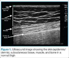 Emergency Ultrasound: Soft-Tissue Assessment | MDedge Emergency Medicine