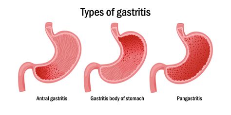 Tres Tipos De Gastritis Ilustraci N Vector En Vecteezy