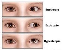 How to treat amblyopia in adult with electronic flicker glasses.