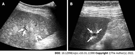 Primary Hepatic Angiosarcoma A Case Report