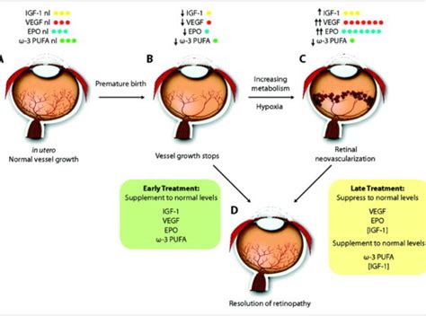 Retinopathy Of Prematurity Stages Complications Causes And Risk Factors