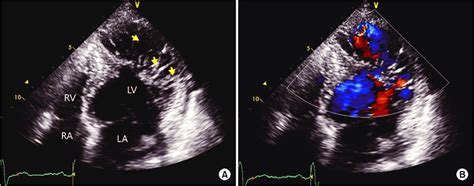 A Preoperative Transthoracic Echocardiography Tte Shows The