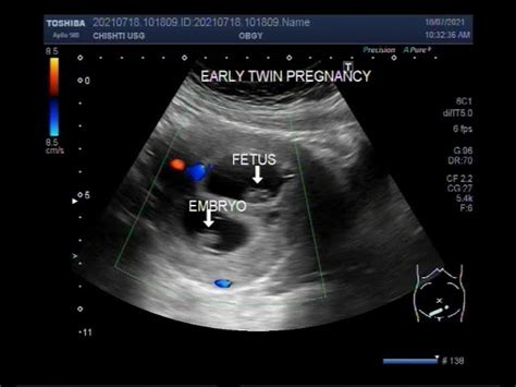 8 Week Ultrasound Pictures Twins