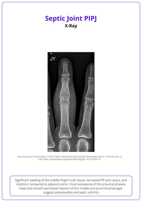 Septic Arthritis Of The Hand Causes Diagnosis Treatment