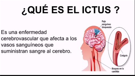 Que Sintomas Tiene El Ictus Isquemico O Infarto Cerebral Youtube ...