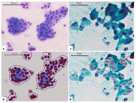 A The Image Of Giemsa Stained Touch Smear Cytology Of Well