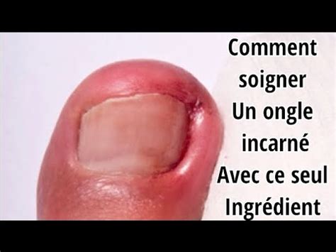 Comment soigner un ongle incarné naturellement YouTube