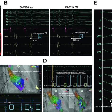 A Intracardiac Electrogram And Fluoroscopic Image At The Moment Of The