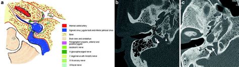 Foramen jugulare Tıpacı