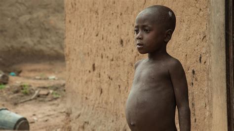 Malnutrition Protein Deficiency Surge In Nigeria Amid COVID 19