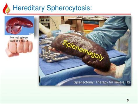 1000+ images about hereditary spherocytosis on Pinterest | Red blood ...