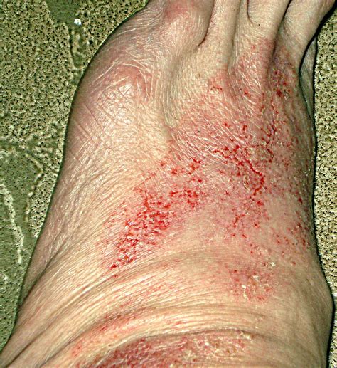 StRaDdLiNg ReAliTiEs: Morgellons: The Disease that Doesn't Exist, But Does.