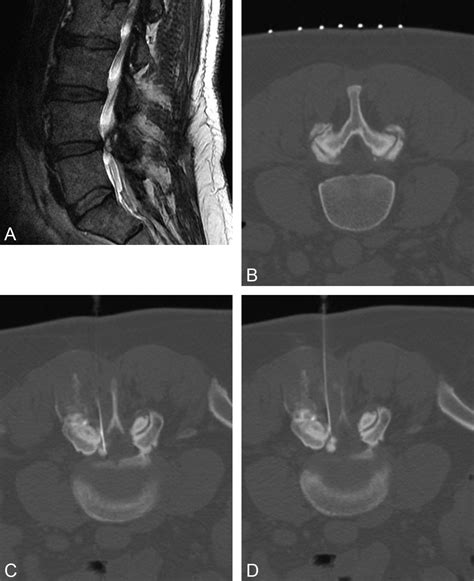 Role Of Facet Joints In Spine Pain And Image Guided Treatment A Review