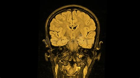 Human Mri Brain Scan On Black Background Computed Tomography Of The Human Brai Stock Footage