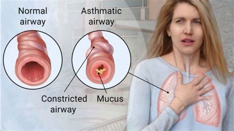 Allergic Asthma Symptoms Youtube Asthma Symptoms Asthma Treatment