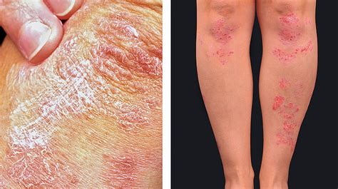 Psoriasis And Neurodermatitis Treatments And Measures