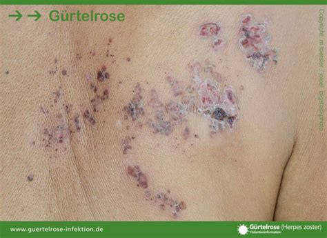 G Rtelrose Patienteninformationen Zu Herpes Zoster