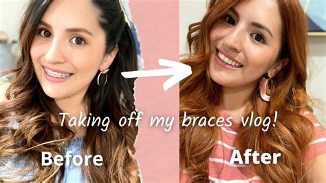 Taking Off My Braces Vlog Youtube