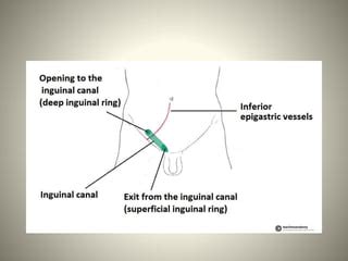 inguinal hernia anatomy | PPT