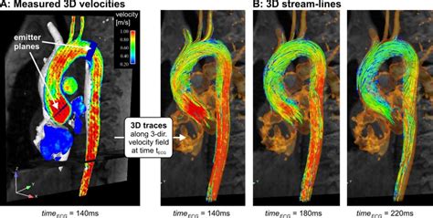 Flow Analysis In Aortic Artery Using D Phase Contrast Mri Images Show