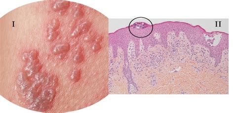 Vesicle Skin Lesion