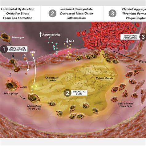 Atherosclerotic Plaque Initiation And Progression—the Nexus Of Lipid