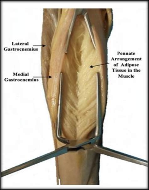 Posterior View Of Left Gastrocnemius Muscle The Medial Gastrocnemius