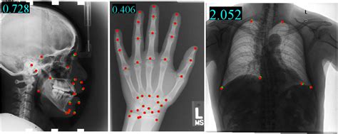 Yolo Universal Anatomical Landmark Detection