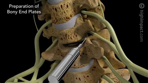 Anterior Cervical Discectomy With Fusion Youtube