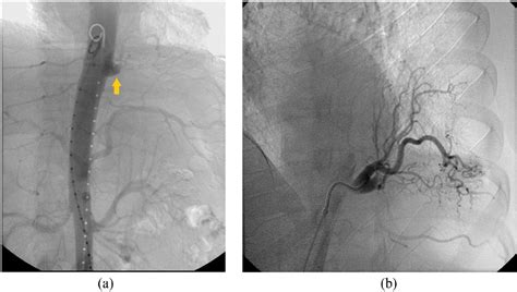 Figure 2 From Embolization Of Symptomatic Intralobar Pulmonary