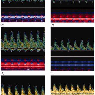 Transcranial Doppler Ultrasound For Detecting Ischemic Cerebrovascular