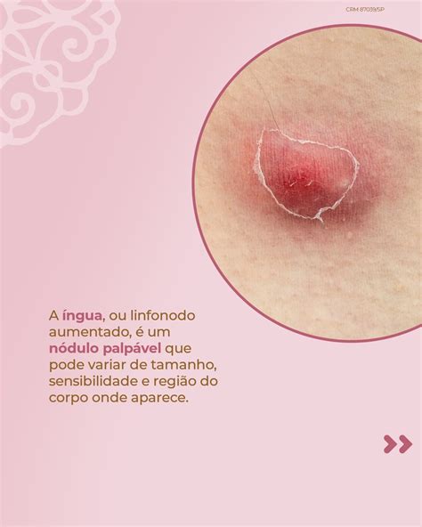 O Que Pode Ser Ingua Na Axila - Linfonodomegalia Axilar Resumo De Linfonodomegalia: Diagnóstico,