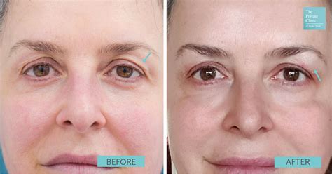 Under Eye Lift Without Surgery