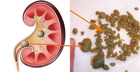 PIEDRA EN LOS RIÑONES Aprende a Cómo Limpiarlos en Sólo 6 Días