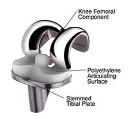 Knee Replacement Surgery: Procedure, Types and Risks | HSS